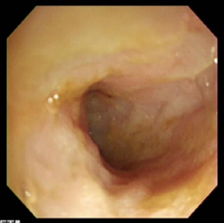 炎症性腸疾患（IBD）