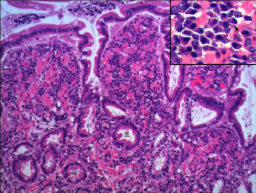 炎症性腸疾患（IBD）