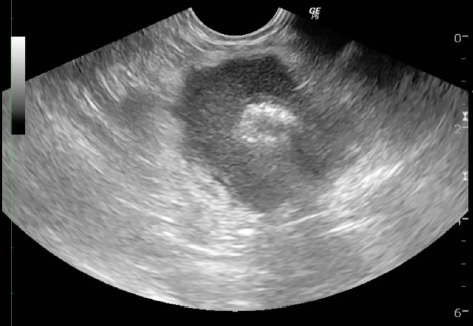 腹部の超音波検査　小腸に直径4cmほどの腫瘤